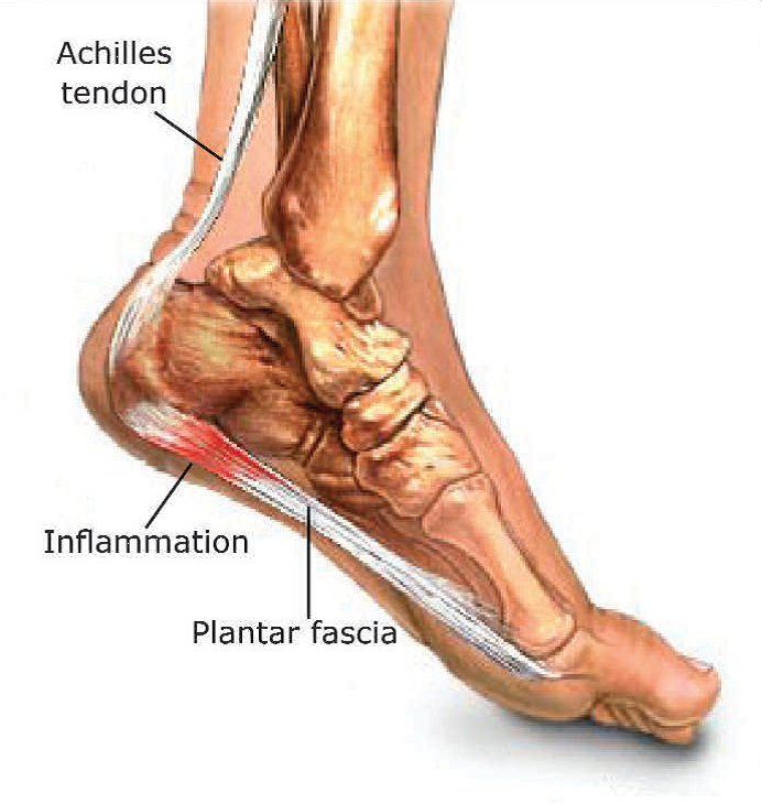 inside heel pain